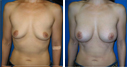Before & After Photos